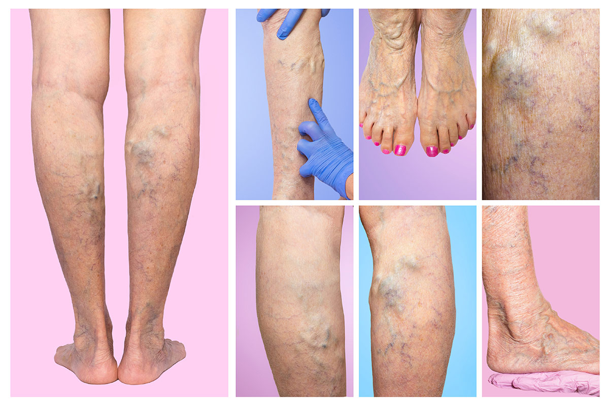 AdobeStock_189926184 Lower limb vascular examination