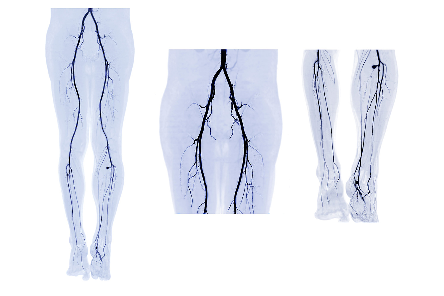 AdobeStock_361595236 Collection of CTA femoral artery run off 3D MIP image