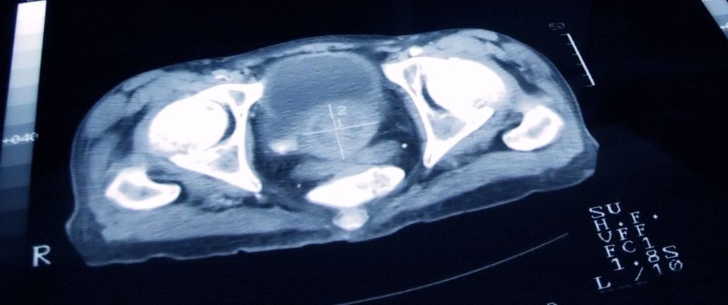 NEPA - Prostate Artery Embolization Prostate Artery Embolization
