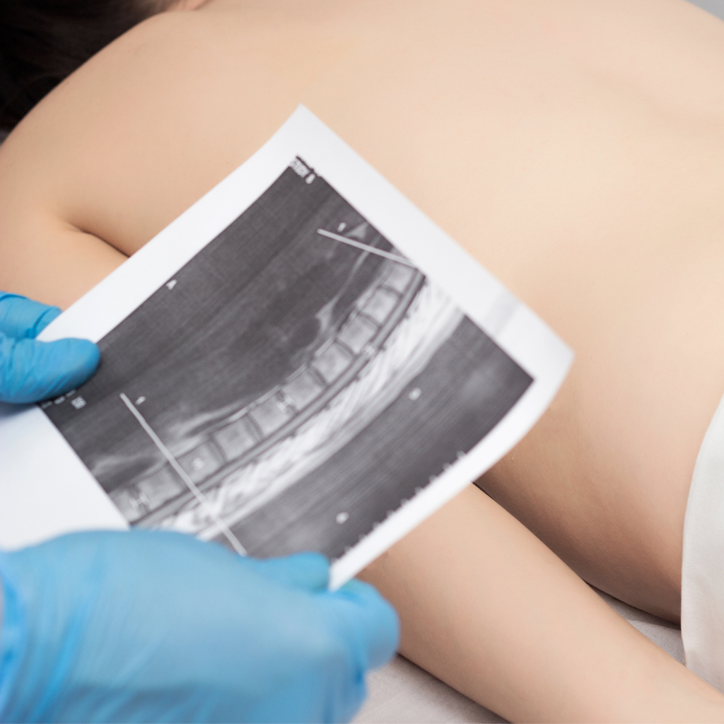 NEPA What Happens Vertebral Augmentation vertebral compression fractures