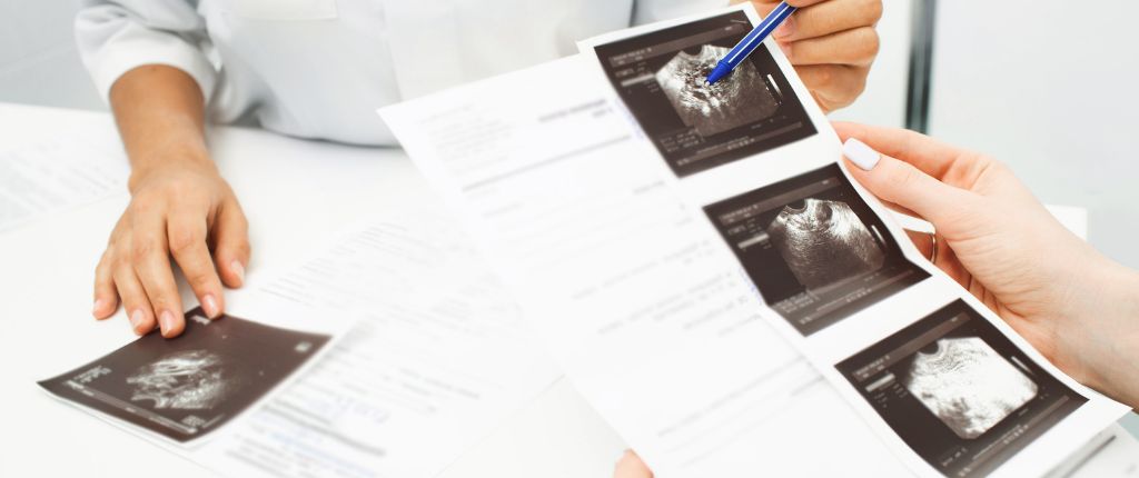 NEPA - What are Uterine Fibroids What are Uterine Fibroids