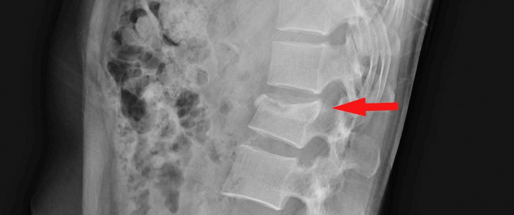 NEPA - vertebral compression fractures Vertebral Compression Fractures