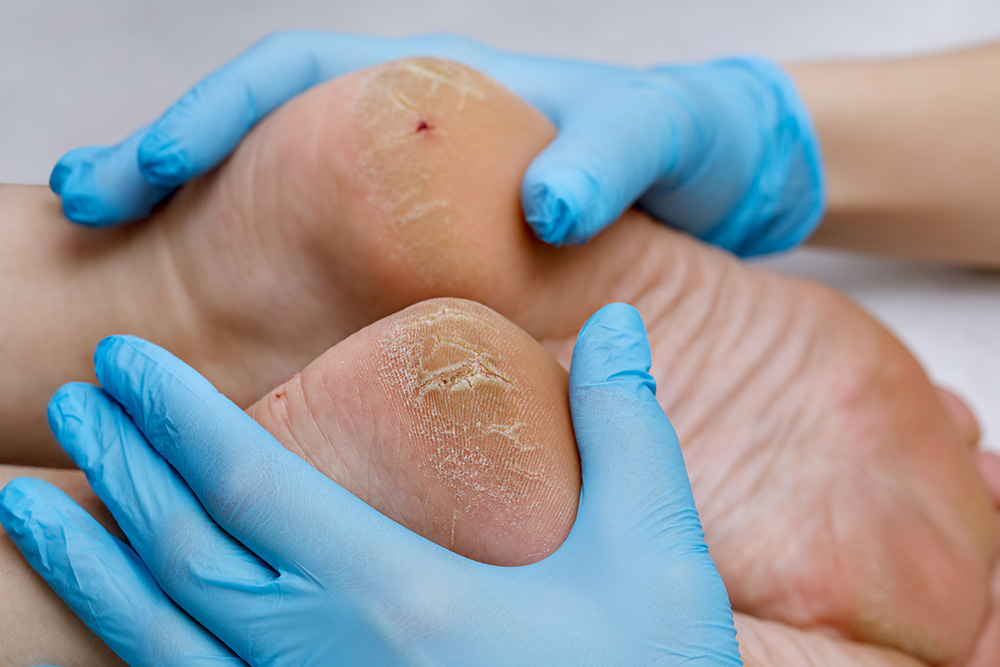 Skin-Cracking-Sores Skin Cracking Sores