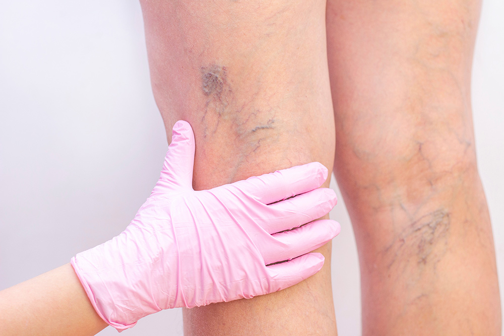Varicose-Veins Varicose Veins