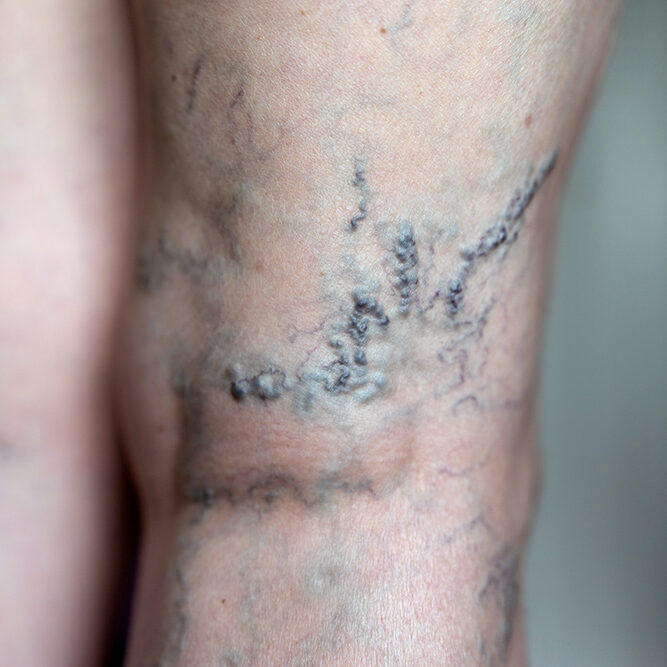 spider veins