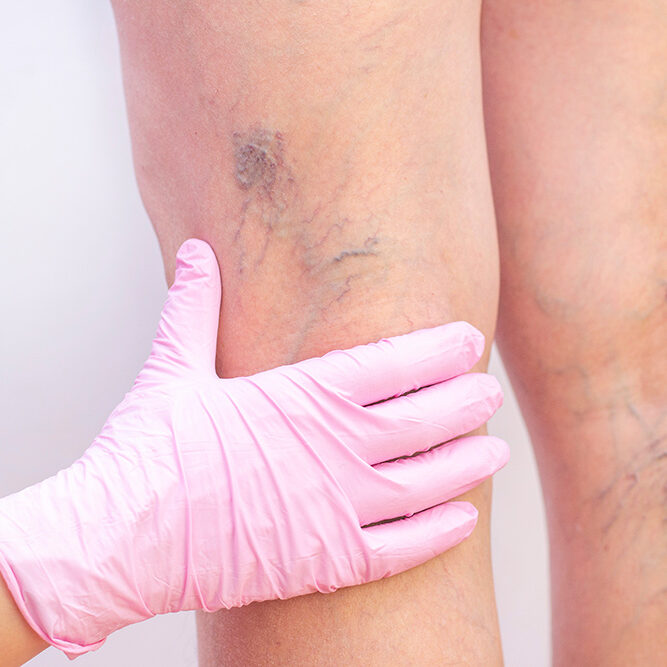 Varicose Veins